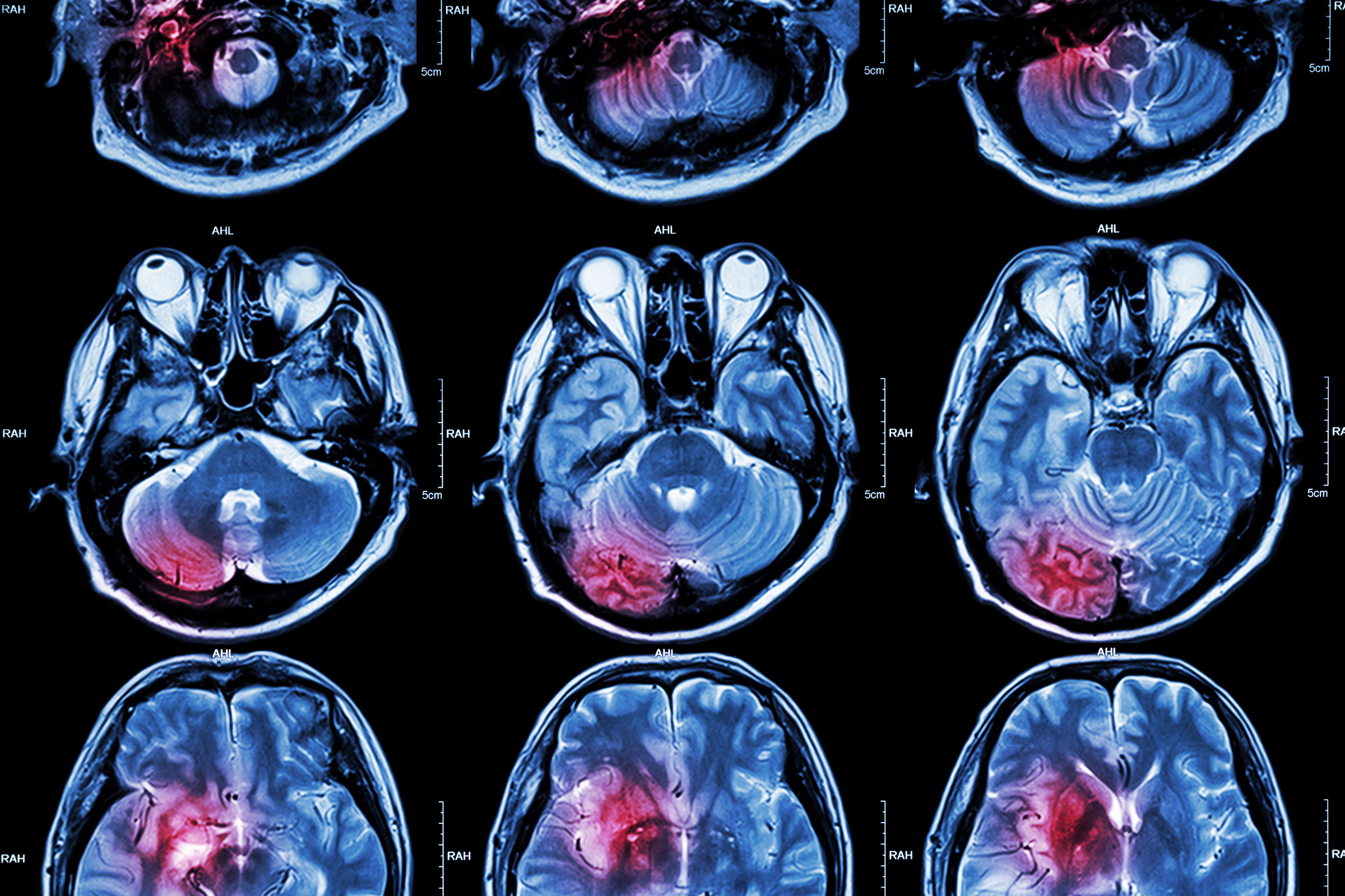 MRI filem - mengimbas tumor otak